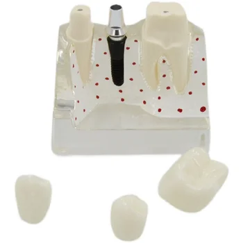 Прозрачный съемный мостовидный протез для 4-кратного ремонта зубной коронки с имплантатом модель комментария стоматолога